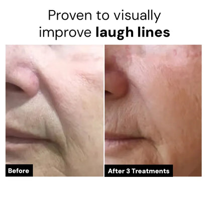 Dr.Meladra™ Micro infusion Patches
